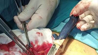 إنقاذ حياة مريض ابتلع سكين مطبخ كبيرا في الدقهلية