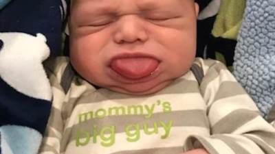 حالة نادرة لطفل أمريكى مولود بلسان 4 أضعاف حجم فمه