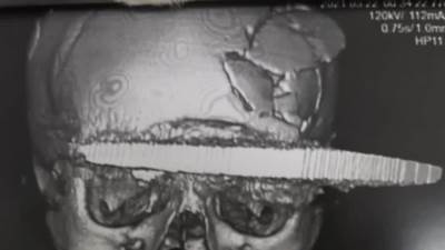 اطباء سوهاج ينجحون في استخراج ساطور من راس امرأة