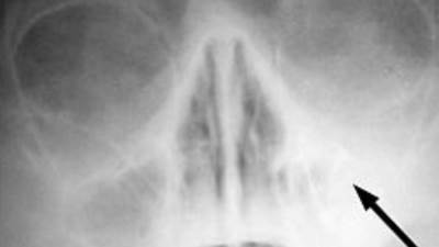 مع سوء الأحوال الجوية يعاني أصحاب مرض الجيوب الأنفية من شدة الالم ف إليكم أهم النصائح 