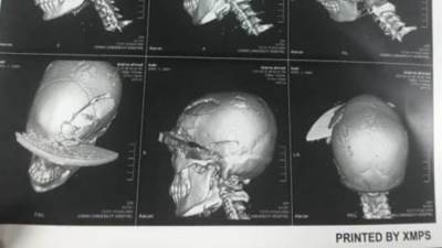 بعد طعنها بالساطور وقطع ثلاثة اصابع تعرف علي تفاصيل الحادث المفجع 