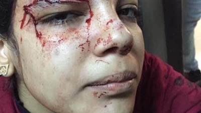 اراد خطبتها فرفضت فقرر ان يكون عقابها ان يشوهها بالساطور شاهد بالصور . 