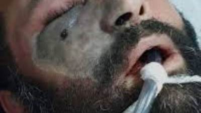 ما هى عدوى الفطريات السوداء المرتبطة بفيروس كورونا وأعراضها؟