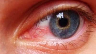 الصحة: 11 فئة أكثر عرضة للإصابة بالفطر الأسود.. وإزالة العين والفك بعض مضاعفاته