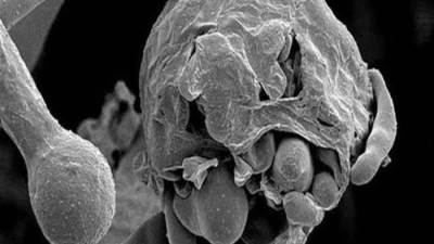 الصحة .. الفطرالأسود يصيب ضعاف المناعة الشديدة ونادر الإصابة بين الأطفال