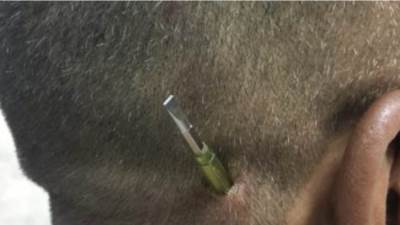 مستشفى سوهاج الجامعي ينجح في استخراج مفك طوله 10 سم من رأس مواطن