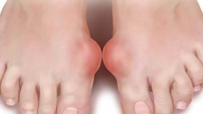 تعرف على أعراض النقرس وأسبابه وطرق علاجه