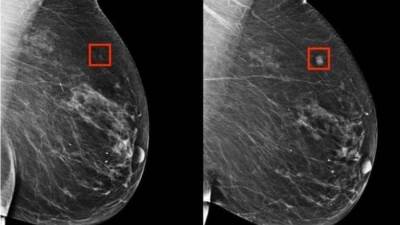 "لا داعي لاستئصال الثدي حال اصابته بالسرطان".. اكتشاف جديد ينقذ سيدات العالم