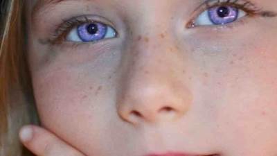 كل ما تريد معرفته عن "متلازمه اليخاندريا" أو "متلازمة الاسكندرية"