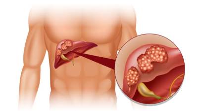لأول مرة في مصر .. علاج مجاني لمرضى سرطان الكبد