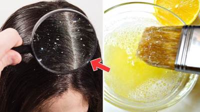 الاسبرين اسهل واسرع طريقة للتخلص نهائيا من قشر الشعر