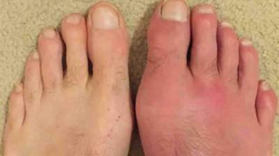 أسباب النقرس.. أشهرها«السمنة» وأفضل الأطعمة للحمايه منه