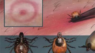 فيروس خطير يصيب الدماغ ويسبب الرعب في أمريكا