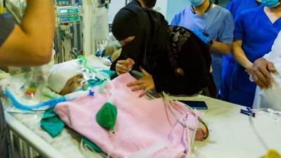 نجاح فصل التوأم السيامي اليمني" يوسف وياسين" بعد عملية استغرقت 15 ساعة