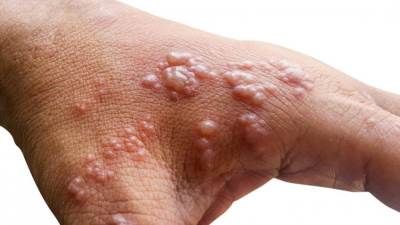 اكتشاف أول حالة يشتبه بإصابتها بجدري القرود في باريس