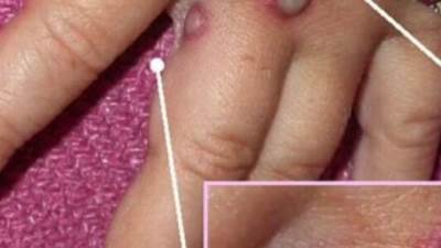 تعرف علي طرق الوقاية من جدوي القرود..