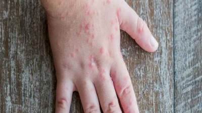 ما هو وأعراضه وطرق الوقاية منه.. كل ما تريد معرفته عن إنفلونزا الطماطم 