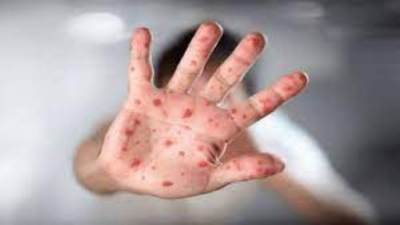 إصابة حالتين بـ جدرى القرود في المجر والنرويج 