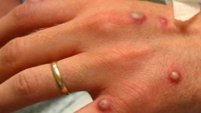 إصابة 33 حالة بـ جدري القرود في فرنسا