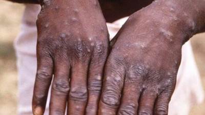 "الصحة" تكشف طرق الوقاية من مرض "جدري القرود"