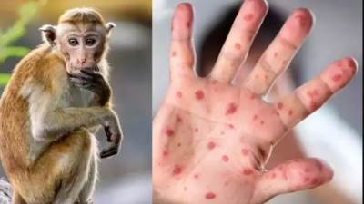 الصحة: لايوجد علاج محدد لجدري القرود ويجب اللجوء للأدوية التي تعالج الأعراض