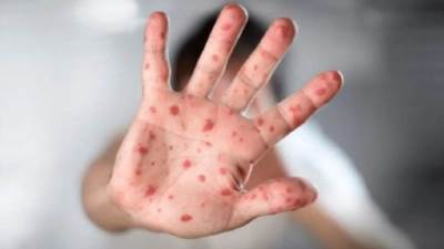 الصحة العالمية تعلن الرقم النهائي لـ حالات الإصابة بـ جدري القرود 