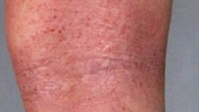 أمراض تزداد فرصة أصابتها في الحر