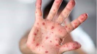 وزير الصحة الفرنسي يعلن عن اصابة 1700 شخص بجدري القرود