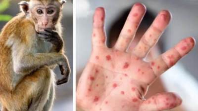 الصحة تؤكد عدم رصد أي حالة "جدري القرود" في مصر حتى الآن 