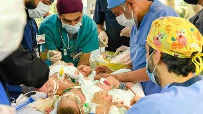 بدء عملية فصل التوأم السيامي اليمني مودة ورحمة