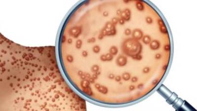 ولاية نيويورك الأمريكية تعلن حالة الطوارئ بسبب جدرى القرود