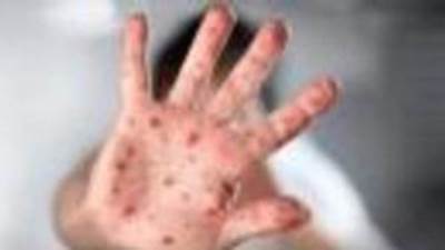 أمريكا تقترب من إعلان " جدري القرود" حالة طوارئ عالمية 