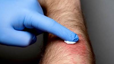 تأثير العلاج بالكورتيزون على الجلد .. تعرف عليه