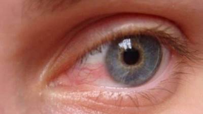 بعد انقطاع الطمث .. هكذا تواجهين جفاف العين