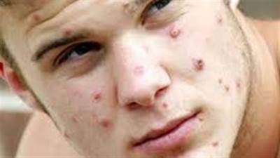 إيطالي يصاب بـ كورونا وجدري القرود والإيدز في نفس الوقت