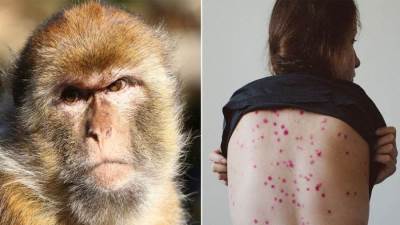 بريطانيا: رصد سلالة جديدة من فيروس جدري القرود