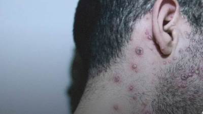 تسجيل أول حالة مصرية مصابة بجدري القرود.. تفاصيل