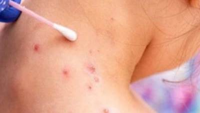 الفرق بين جدري القرود والجدري المائي