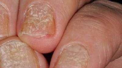 نصائح ذهبية للعناية بالأظافر المتشققة