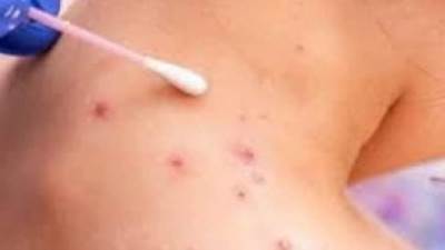 البحرين تسجل أول حالة مصابة بـ"جدري القردة"