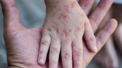 مسؤول صيني: لا تلمسوا الأجانب للحد من خطر الإصابة بجدري القرود