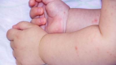 أعراض مرض اليد والقدم والفم لدى الأطفال .. تعرف عليها