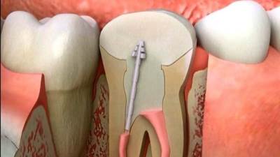 التهاب جذر السن .. أسبابه وأعراضه