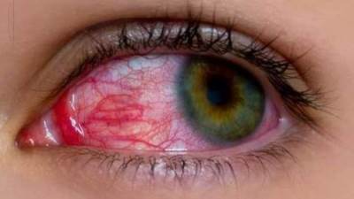 احمرار العين .. متى يستلزم استشارة الطبيب؟