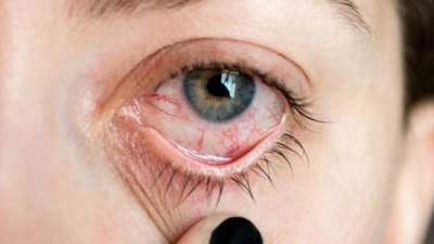 التهاب قزحية العين .. الأسباب والأعراض