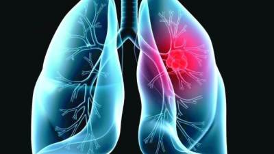 أعراض تكشف سرطان الرئة.. تعرف عليها