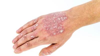 هل يحتاج مرضى الصدفية إلى العلاج النفسي؟ 