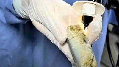 استخراج هاتف محمول من معدة شاب بمستشفى المنصورة الجامعي