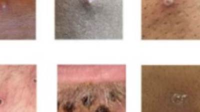 الصحة: حالة المصاب بجدرى القرود مستقرة وتتلقى العلاج