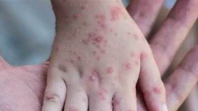 متحدث الصحة: جدرى القرود لا ينتشر بسهولة